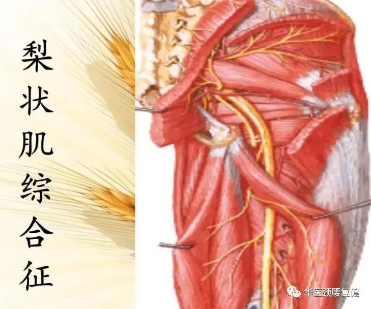 腰椎间盘突出压迫神经屁股疼腿疼,屁股两侧上方酸痛是不是腰椎突出