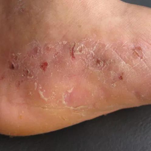 脚底发凉是猝死的前兆吗,脚底脱皮是不是大病前兆