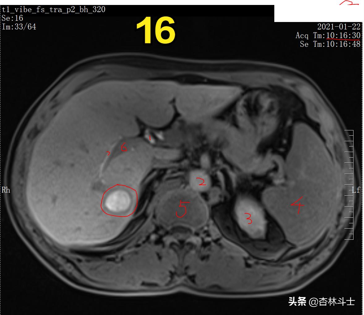肝癌8公分肿瘤能活多久,肝癌细胞最大长多大