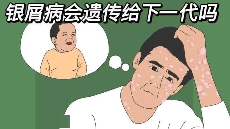 牛皮癣会遗传给胎儿吗,牛皮癣银屑病会遗传给下一代吗