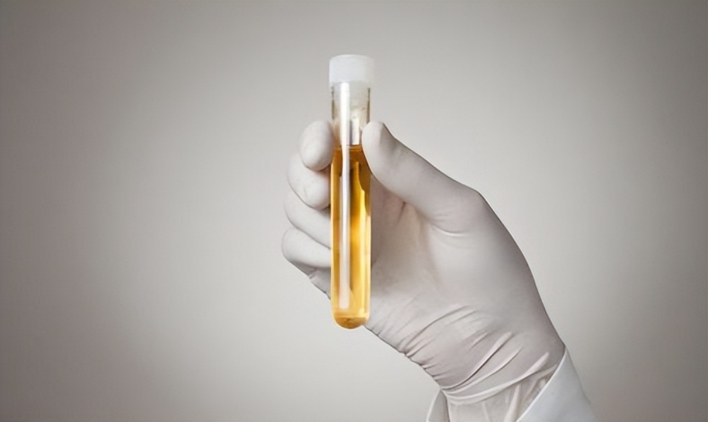 小便完还是一直有尿意查什么,尿液早期有4种信号