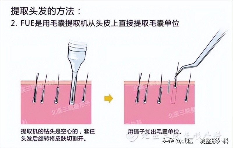 注射除皱发际线提升有什么效果,除皱注射到发际线可以提升吗