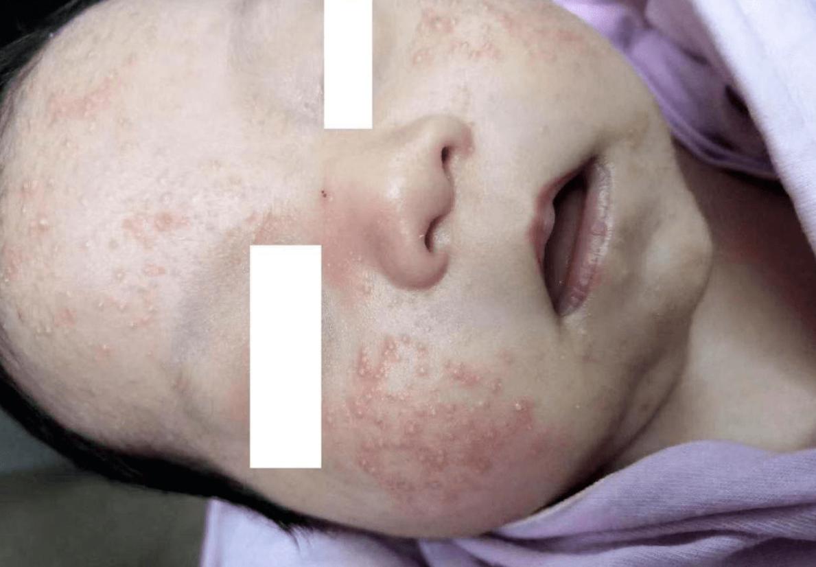 两个月宝宝脸上长小红痘痘痒,两个月宝宝用了面霜长痘痘了