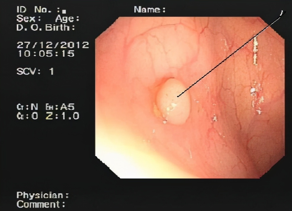 长息肉该注意怎么饮食,长了息肉会有什么症状