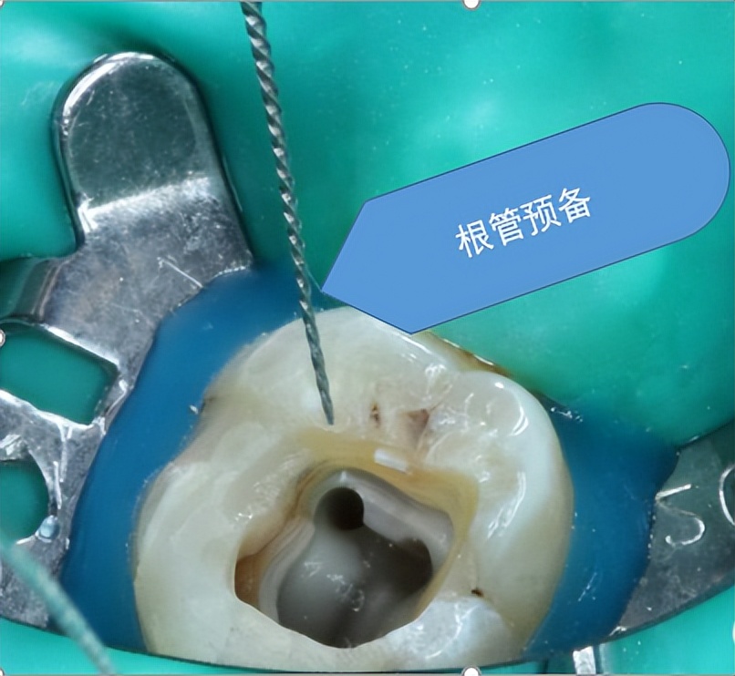 烂牙做根管治疗,烂牙做牙套好吗