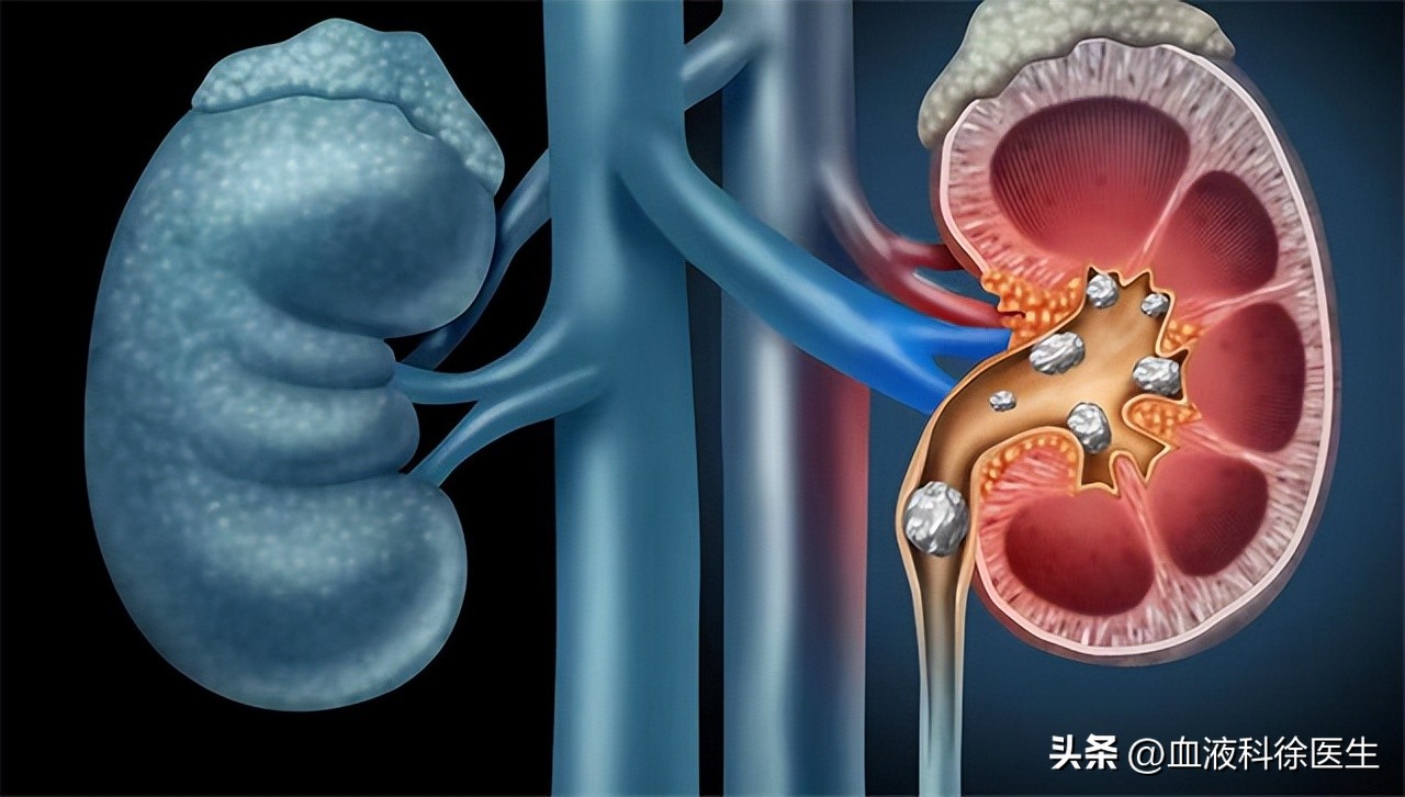 肾衰竭有这5个征兆不痛不痒,肾衰竭为什么就不排水了
