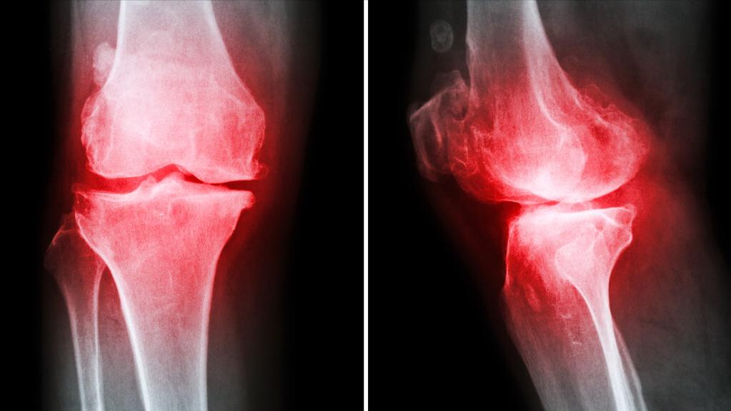 骨性关节炎骨刺有什么方法能消肿,吃什么药可以治疗骨刺和骨关节炎