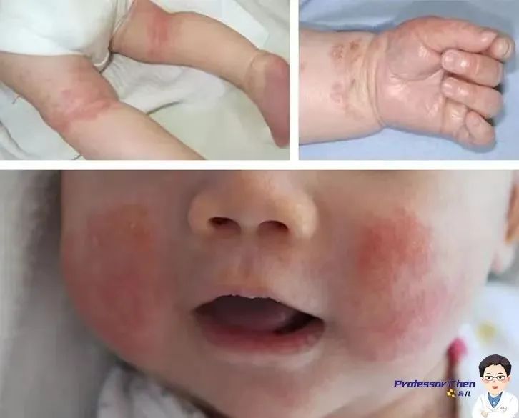 宝宝湿疹“痒痒痒”，按照攻略走，快速止痒去湿疹