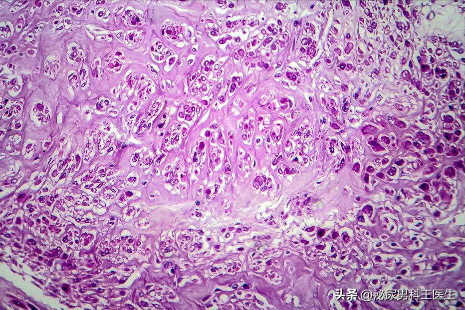 大部分女性都会长子宫肌瘤吗,如何防止长子宫肌瘤