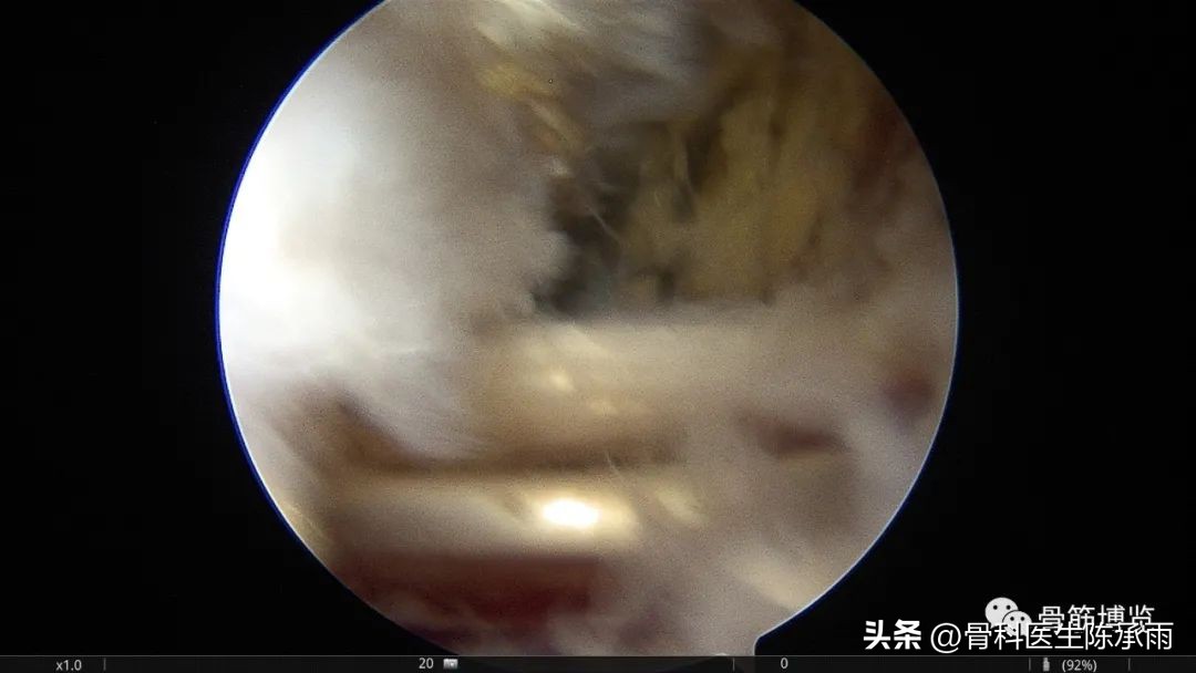 腘窝囊肿关节镜下切除复发,膝关节镜下腘窝囊肿切除的原理