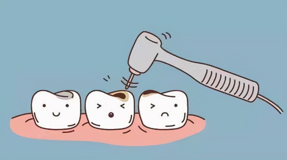 龋齿很小医生说不用补,龋齿不疼去补要做根管治疗吗