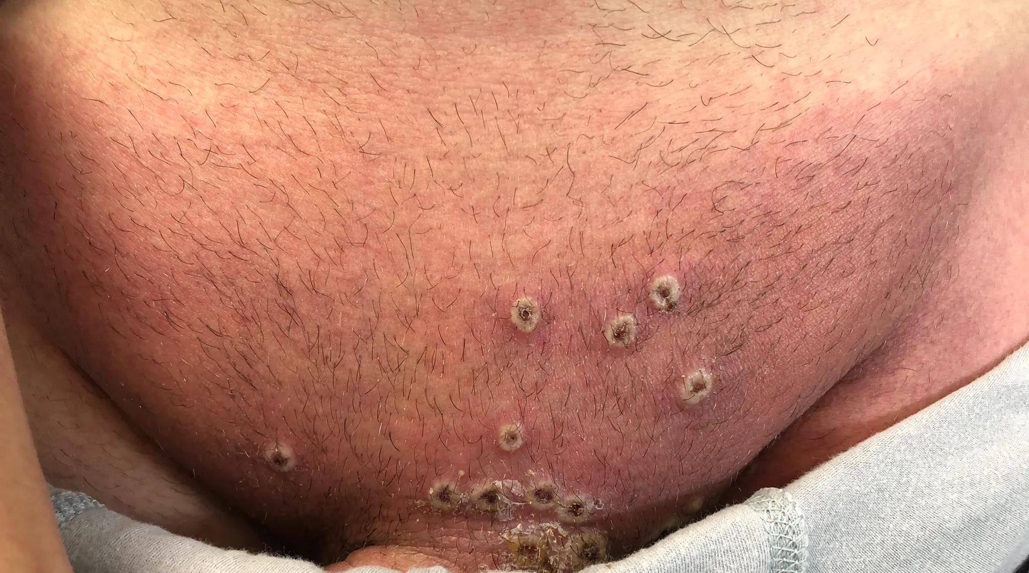 猴痘开始在西班牙蔓延感染方式诡异欧洲各国开始考虑买疫苗