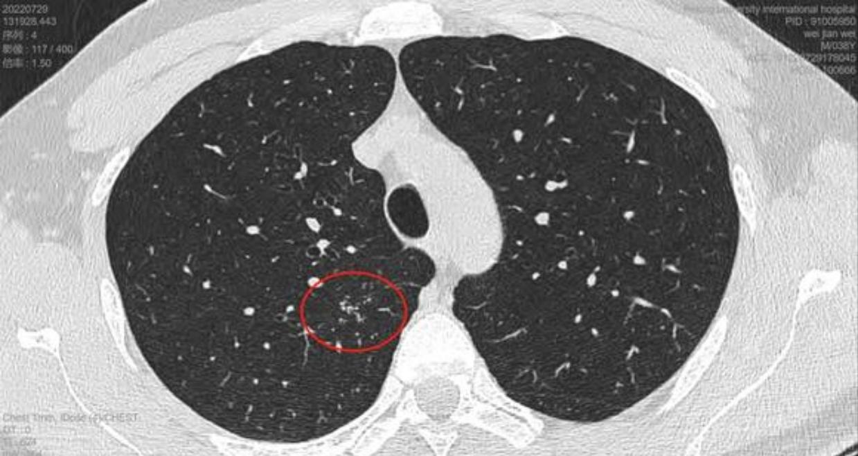 磨玻璃结节9*8mm建议随访,8mm磨玻璃结节一年没长