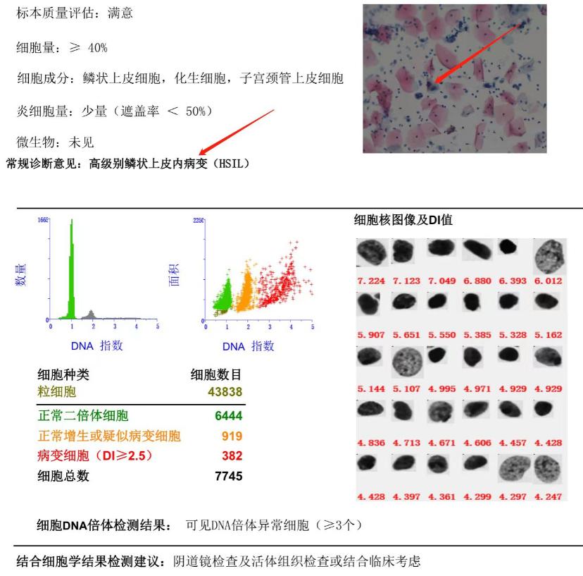 HPV感染和宫颈癌的预防与早期发现