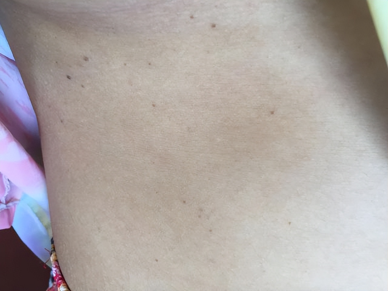 错把艾滋当成皮肤病？这些症状切勿忽视，建议及早检查一下