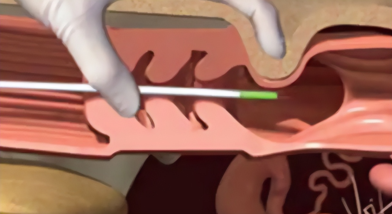 结扎的女性卵子怎么排出来的,女性结扎之后卵子如何排出