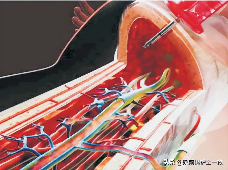 骨髓腔穿刺急救,骨髓腔穿刺适应症和禁忌症