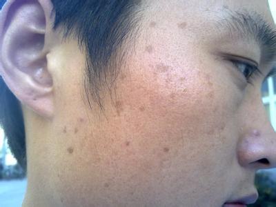 女生产后长痘长斑什么原因,坐月子脸上长很多痘痘怎么回事