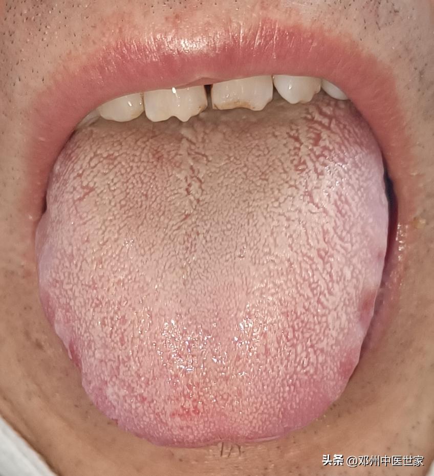 耳鸣耳聋掩蔽疗法,哪一种耳鸣耳聋适合吃通气散