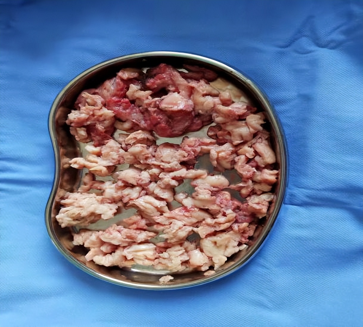 得了子宫腺肌症必须切除子宫吗,子宫腺肌症严重了只能切除子宫吗