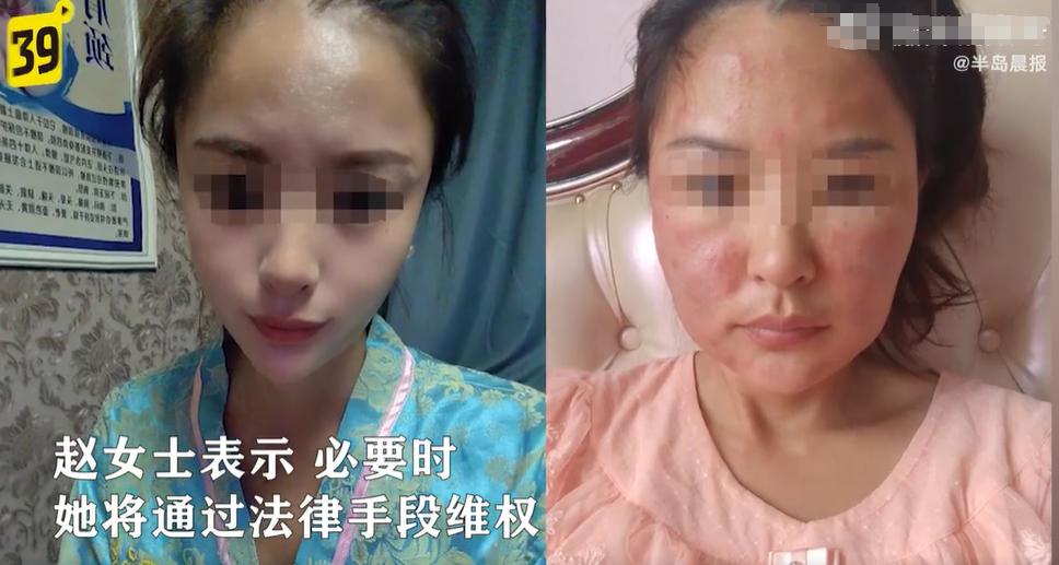大连女孩打美容针毁容,大连一女子打玻尿酸