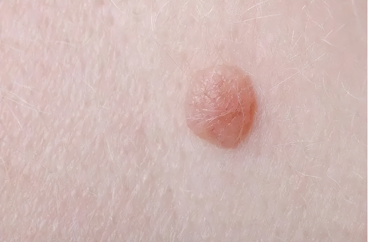 脖子上长的小肉粒可以揪掉吗,脖子和腋下的小肉粒可以揪掉吗