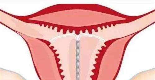 女生一定要知道正确的避孕方法,如何正确有效地避孕