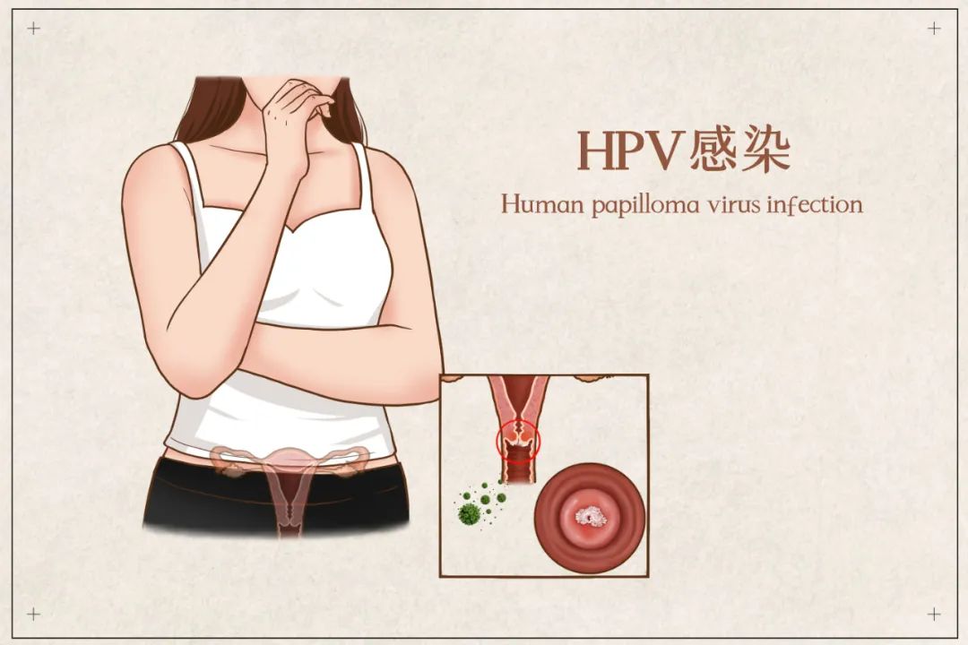 困惑，明明很注意，为什么还感染了HPV
