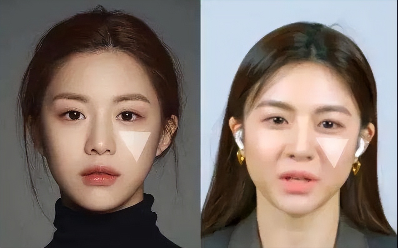 千万别做拉皮手术后遗症太可怕了,拉皮手术会有什么后遗症吗