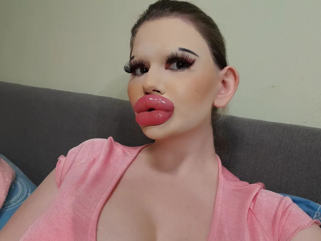 女子狂打30支玻尿酸,丰唇针建议打吗