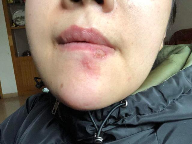 嘴巴旁边很多小水泡会留疤吗,嘴巴周围长一堆小水泡是上火吗