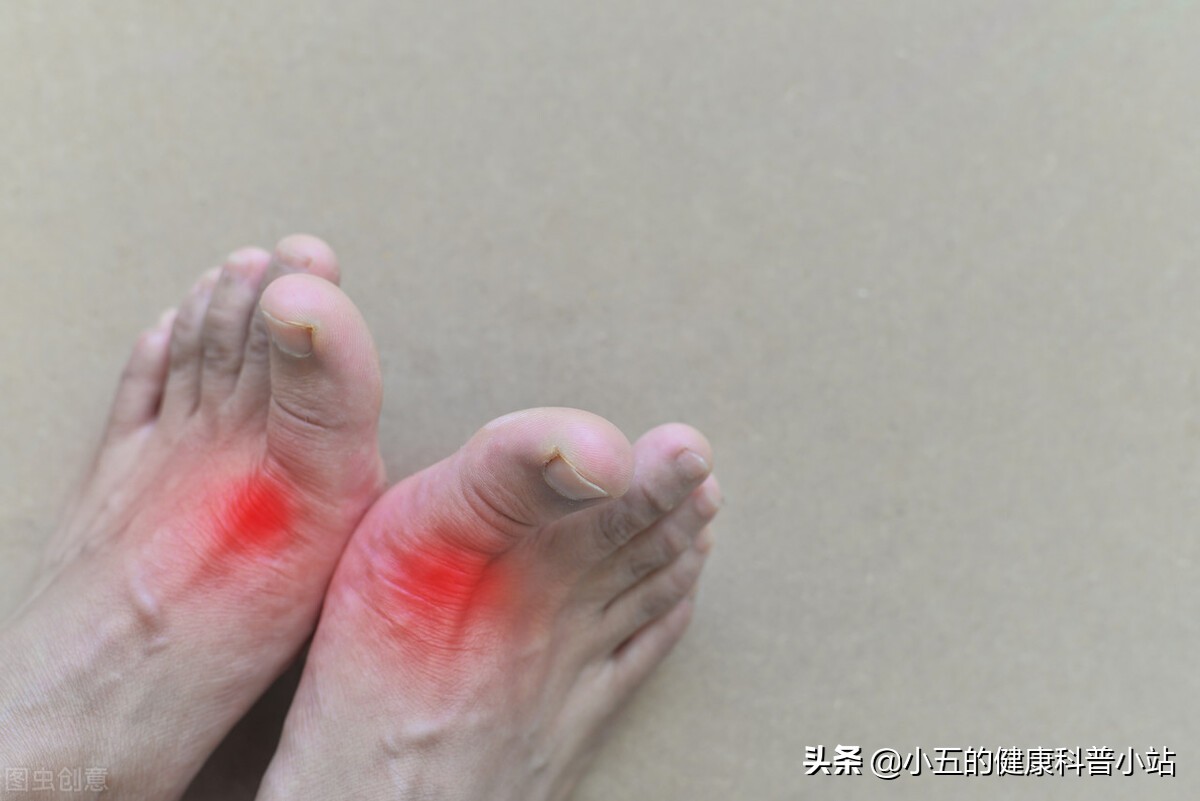 非布司他怎么吃可以根治痛风,吃非布司他痛风发作脚红肿怎么办