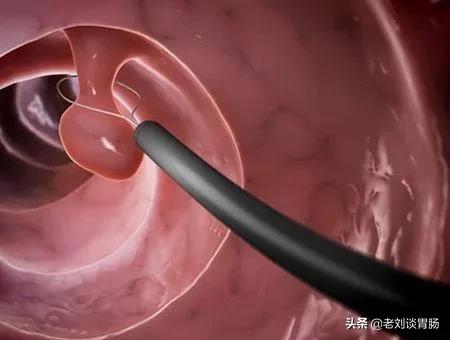 肠镜检查会漏诊肠息肉吗,肠镜检查出息肉怎么治疗