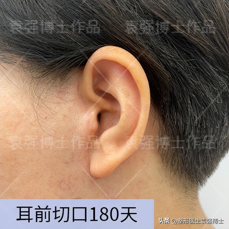 拉皮手术是整形的终极选择吗,整形大拉皮一般多少价格