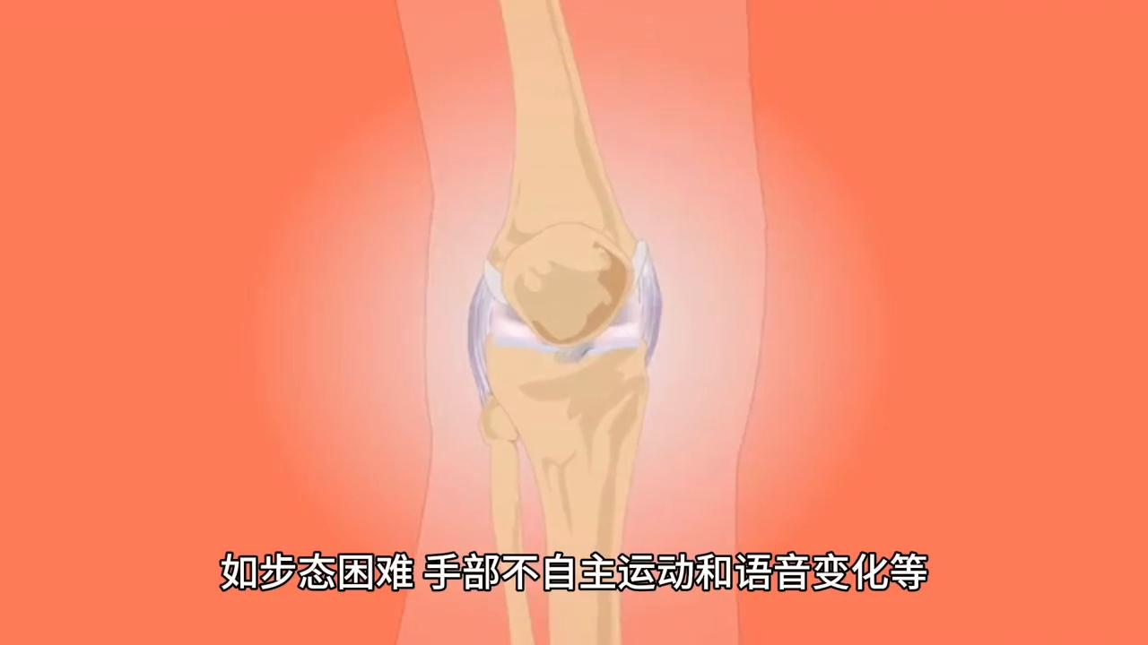 视频涨知识|帕金森病的治疗方法