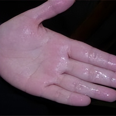 手和脚经常出汗怎么办,手经常出汗怎么治才能除根