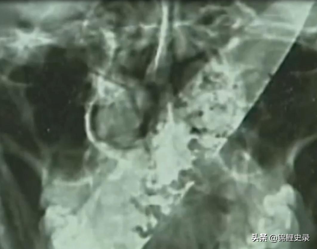 云南男子口臭骇人医生检查惊呼,云南男子口臭传奇故事