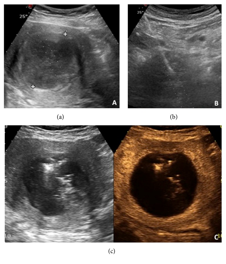 射频消融手术治疗子宫肌瘤效果,子宫肌瘤肌壁间用消融还是海扶刀
