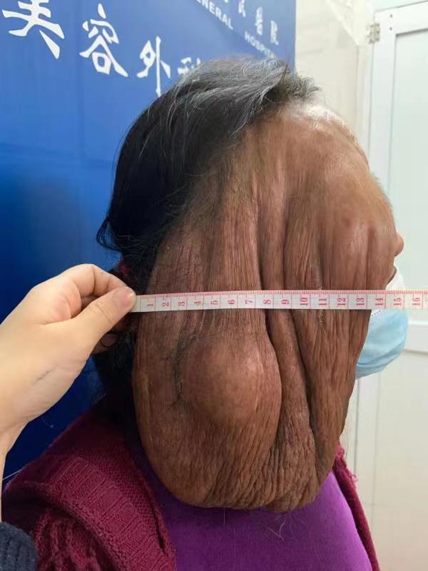 脸颊突然长了很多红色的小颗粒,脸颊两侧突然长了很多小米粒