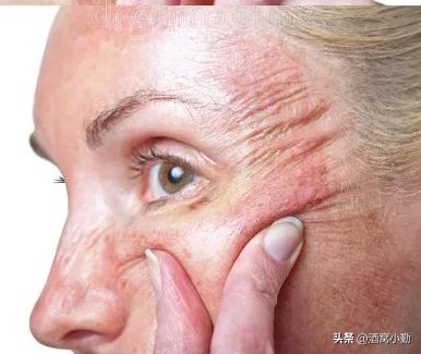 叶黄素会导致皮肤过敏吗,吃叶黄素过敏怎么回事