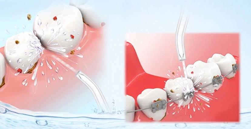 水牙线冲牙器洗牙器,水牙线冲牙器品牌第一名