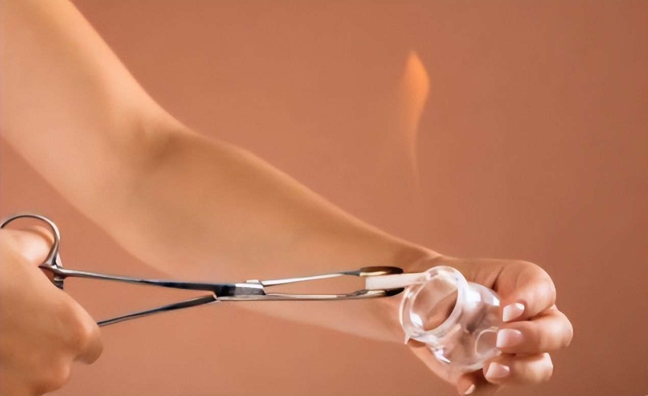 拔火罐出现的瘀血，是体内的毒素吗？