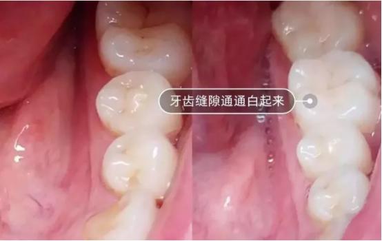 声波电动牙刷的用途有哪些,声波电动牙刷的优缺点