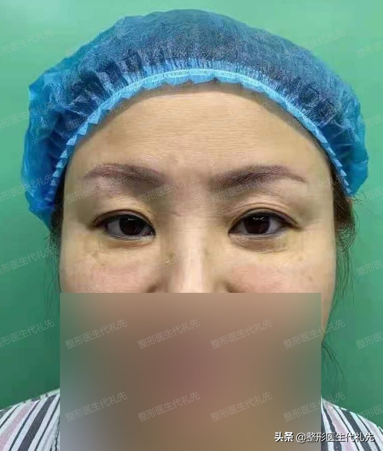 35岁眼周围皱纹多怎么办,35岁眼周有细纹怎么改善