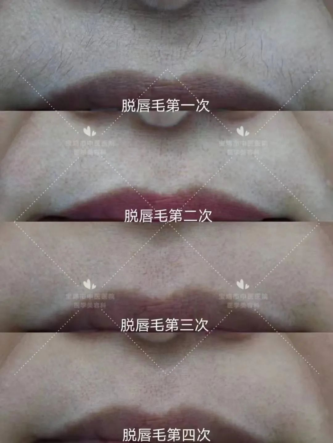 哪种脱毛方法永久脱毛不会再长毛,脱毛小妙招不伤皮