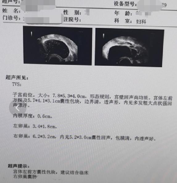 卵巢囊肿拳头大能消除吗,卵巢囊肿需要警惕