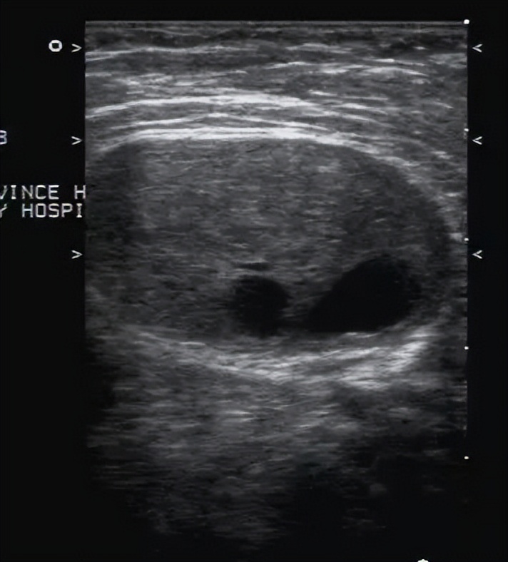 腋窝包块超声鉴别诊断,腋窝淋巴结检查法