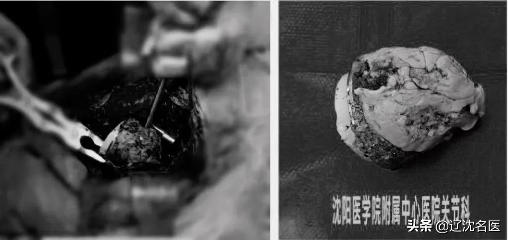 人工髋关节翻修3d打印,大连医院骨科3d打印