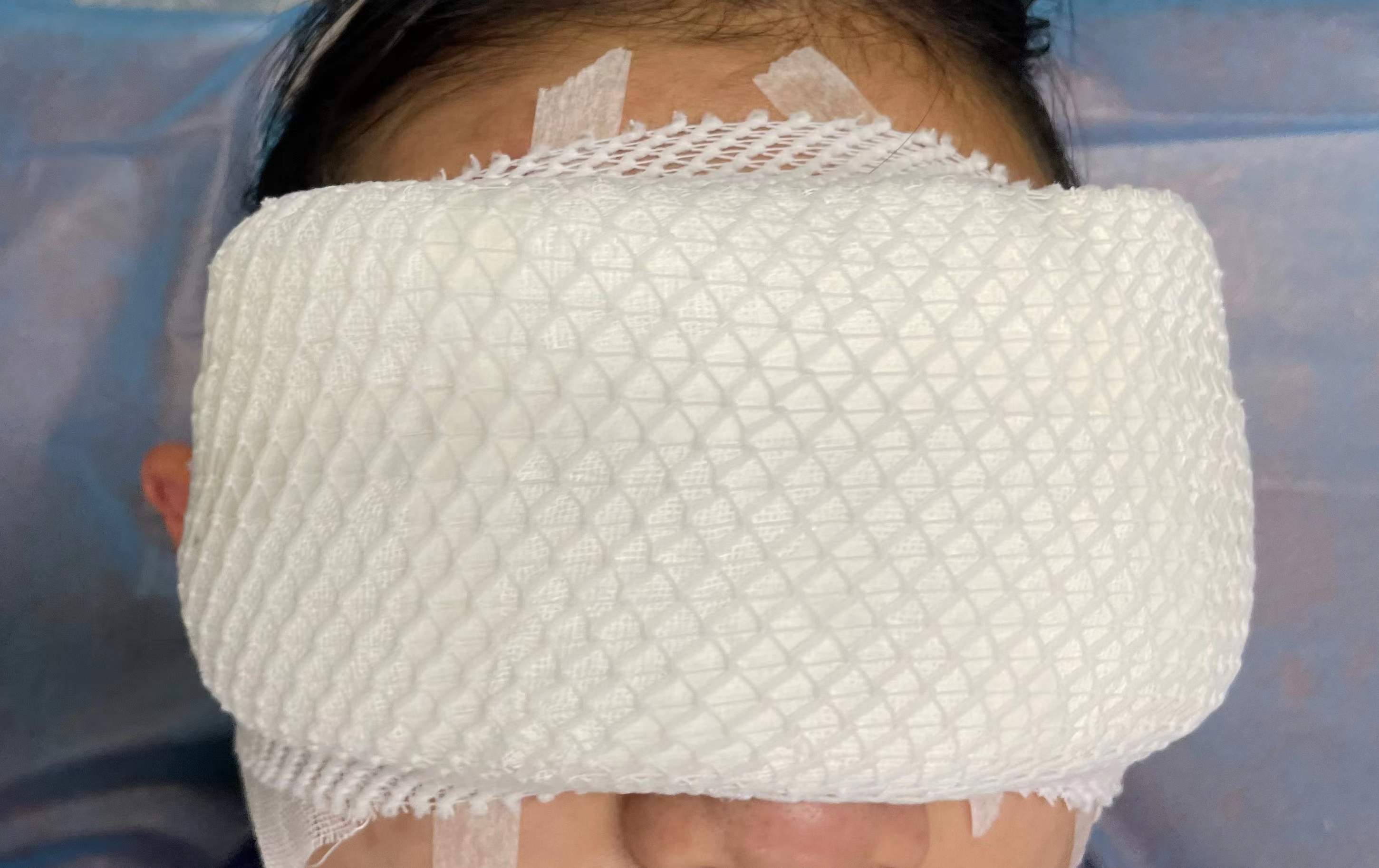 双眼皮手术后眼睛闭合不全怎么治,上睑下垂术后两年眼睛闭合不全