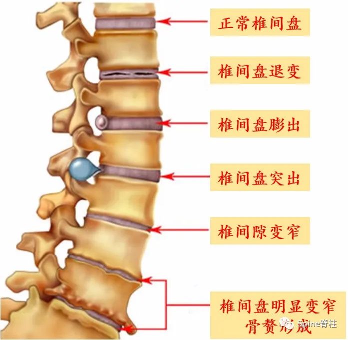 腰椎间盘突出症的治疗方法,腰椎间盘突出症状主要有哪些
